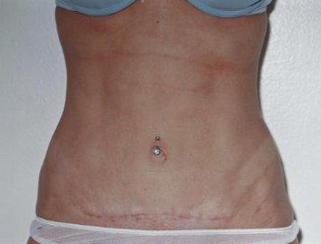 Tummy Tuck - After Treatment Photos - female, front view, patient 3
