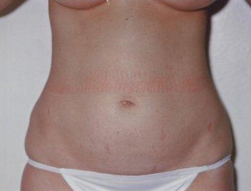 Tummy Tuck - Before Treatment Photos - female, front view, patient 3
