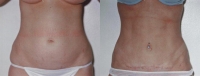 Tummy Tuck - Before and After Treatment Photos - female, front view, patient 3