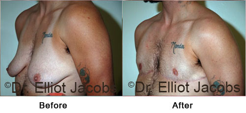 Female to Male Surgery before and after photos